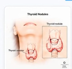 Thyroid