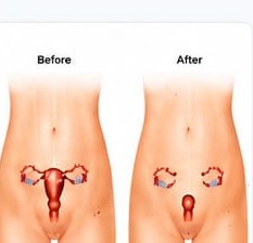 Hysterectomy