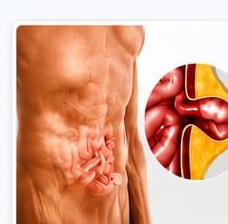 Hernia