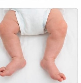 CTEV (Club Foot)