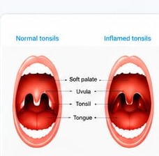 Tonsils